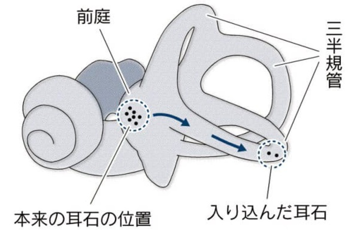 めまいの原因