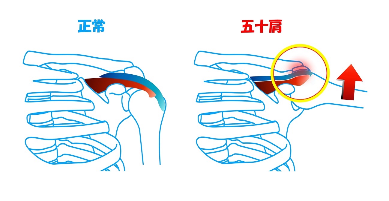 五十肩の原因